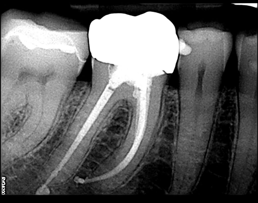 What to Expect During a Root Canal