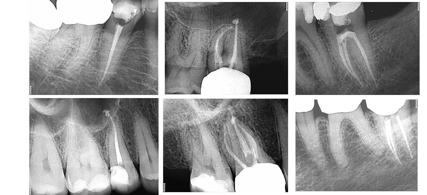 Root Canal Case Reports